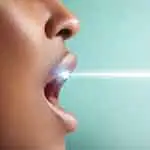 تبييض الأسنان بالليزر