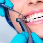 تنظيف كامل للأسنان