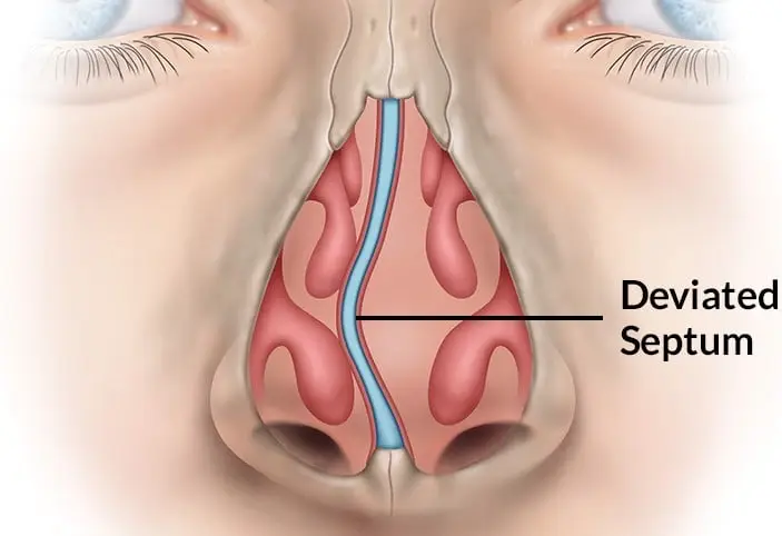 Septoplasty Turkey surgical planning at leading clinic in septoplasty Istanbul with surgeon explaining procedure steps